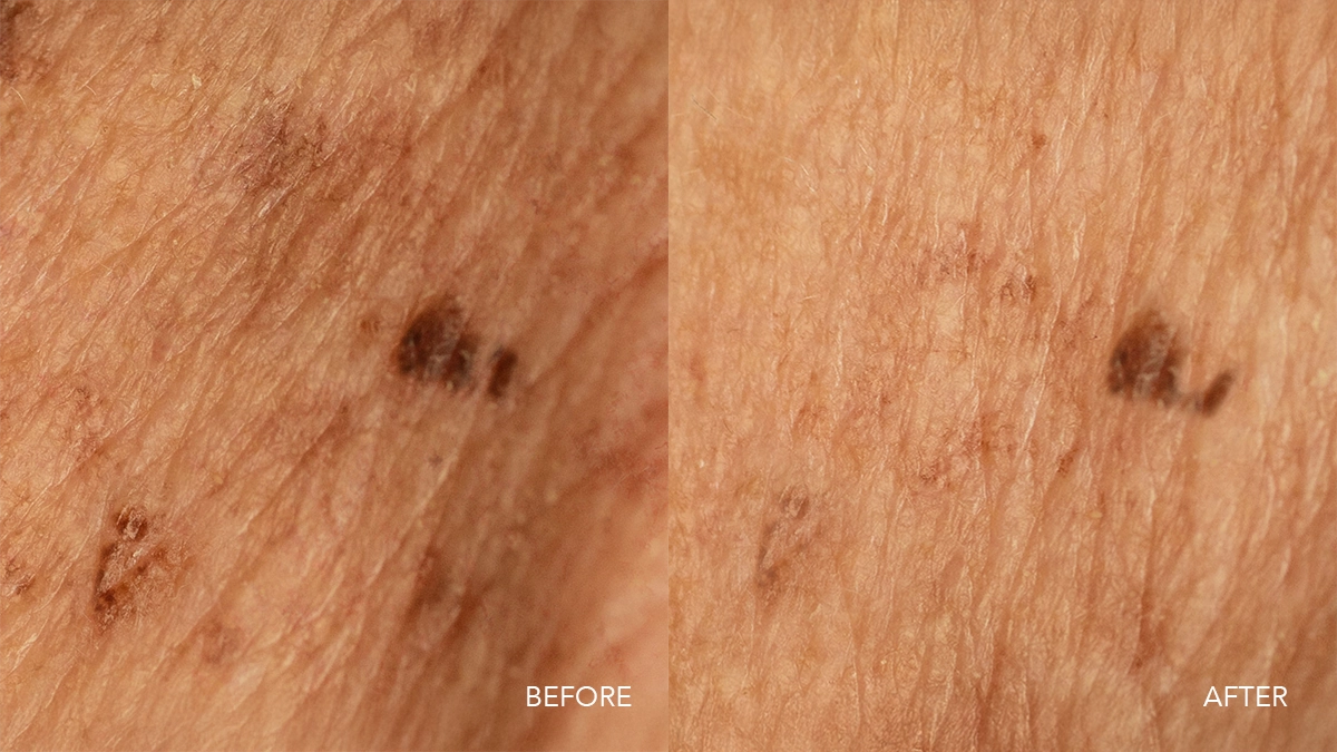 FAQ 502 before after hyperpigmentation, better skin texture, faded hyper pigmented areas, softer texture